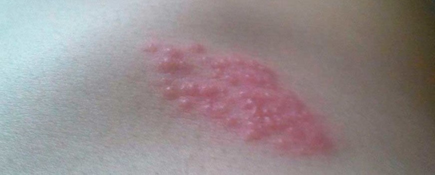 Фото укусов домашнего клопа на теле человека